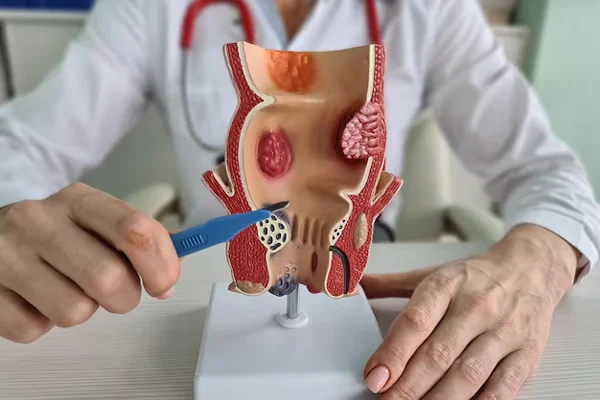 Piles Surgery