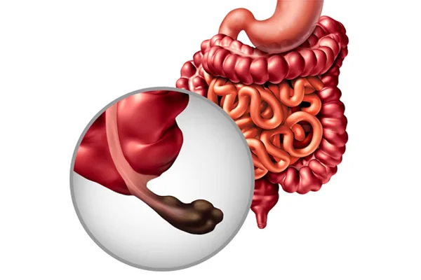 Appendix Surgery