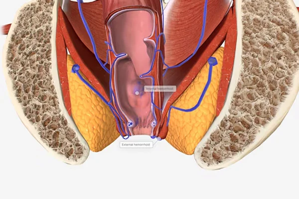 Anal Fistula Surgery