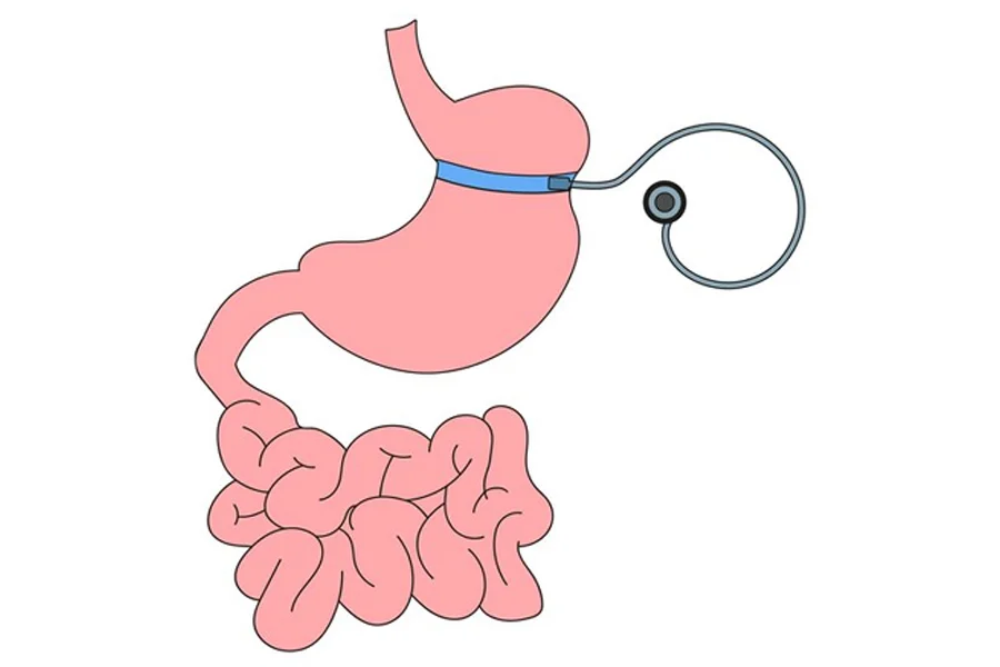 Bariatric Surgery