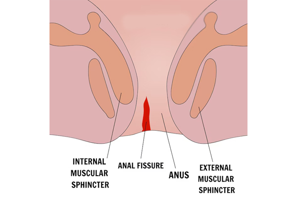 Fissure Surgery