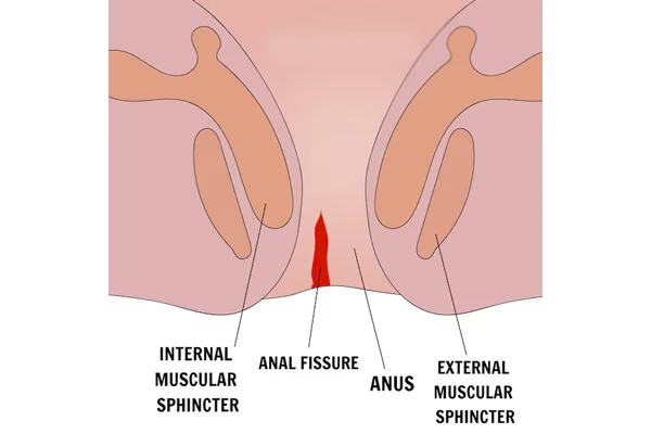 Fissure Surgery