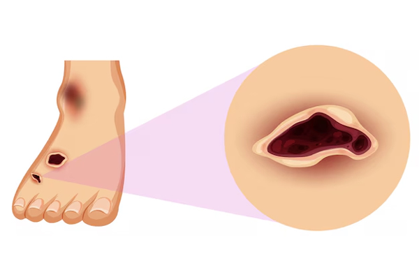 Diabetic Foot Management