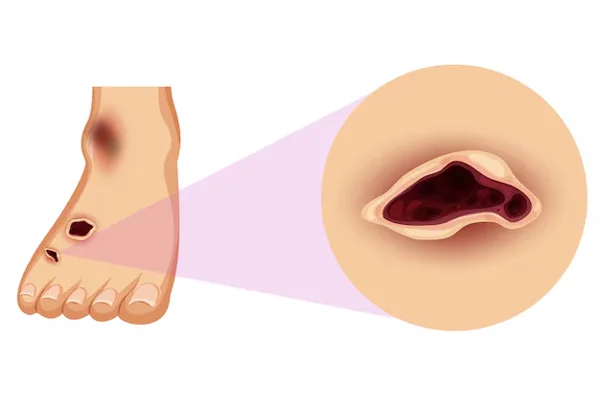 Diabetic Foot Management